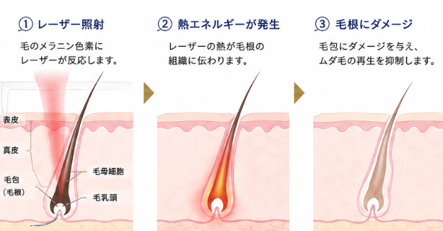 医療レーザー脱毛の仕組み：①レーザー照射 ②熱エネルギーが発生 ③毛根にダメージ